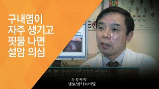 구내염이 자주 생기고 핏물 나면 설암 의심 - (20130302_450회 방송)_먹고 말하는 즐거움을 빼앗기다 - 두경부암