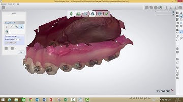 3Shape Ortho Analyzer   How to Debond a Model