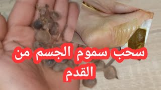 سحب سموم الجسم من القدم علاج الم العظام والمفاصل وتنشيط الدورة الدموية