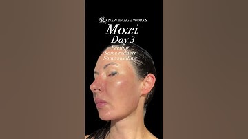 MOXI Laser – Brighten, Tighten & Refresh Your Skin | New Image Works