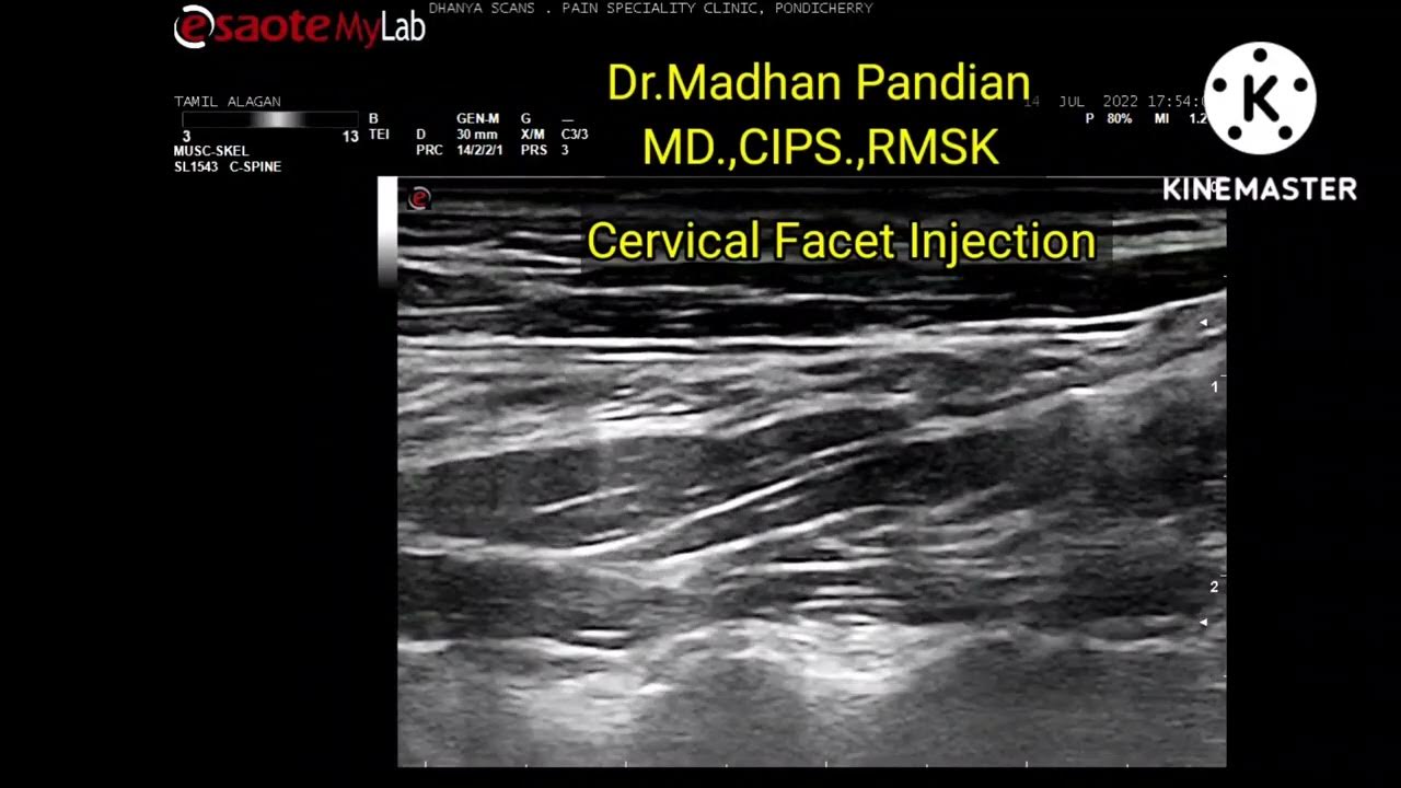 Ultrasound guided Cervical Facet Joint Injection YouTube