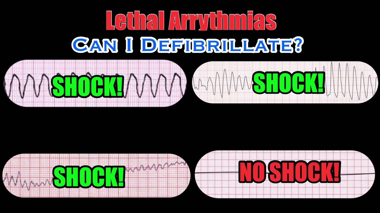 Lethal Arrythmias: Identification and Response