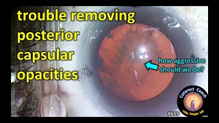tough posterior subcapsular cataract