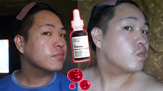 THE ORDINARY CHEMICAL PEELING SOLUTION REVIEW / PHILIPPINES  [ THE ORDINARY AHA 30% BHA 2% ]