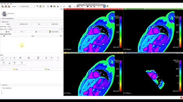 3D Slicer - T1 & ECV Mapping