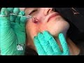 Cyst Excision: Donâ€™t Try This At Home! | The Doctors