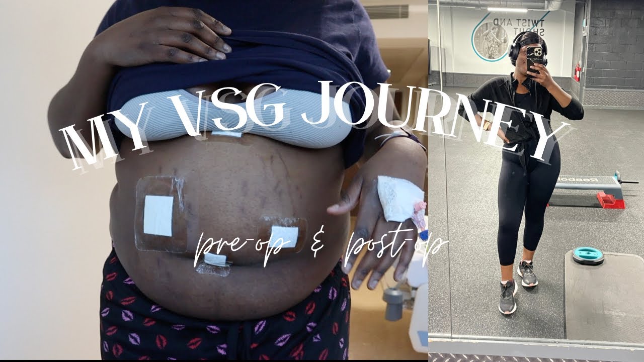 МОЙ ПУТЬ К ПОХУДЕНИЮ С ПОМОЩЬЮ РУКАВНОЙ РЕЗУЛЬТАТЫ ЖЕЛУДКА | ДНЕВНИК ДО И ПОСЛЕ ОПЕРАЦИЙ И ПОТЕРЯ...