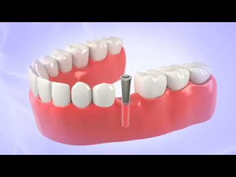 Video: Tandheelkundige Implantatie - Soorten Implantatie, Complicaties En Contra-indicaties