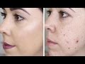 Cómo Maquillar el Acné | Productos Favoritos de Tratamiento