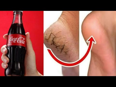 Videó: Torokfájás Kezelése Coca Colával