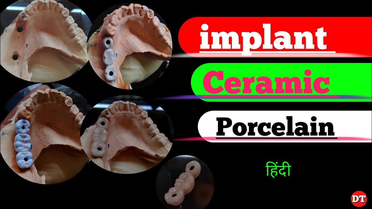 Implant Ceramic porcelain canstable implant Pfm Anatomy Human