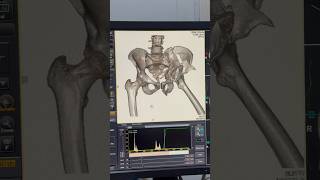 Alert 3D Ct Scan Reveals Multiple Pelvic Fractures From Bike Wheeling Accident Safety Awareness