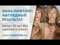 СМАС лифтинг лица – потрясающий результат без швов и рубцов