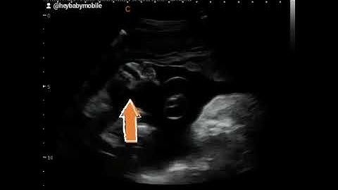 How to get 3D & 4D Ultrasound Face Pictures! Explained!