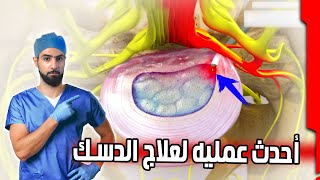 الدكتور قال لازم عمليه؟ ماهي شروط عمليه الدسك وأفضل العمليات الحديثه ونسب النجاح