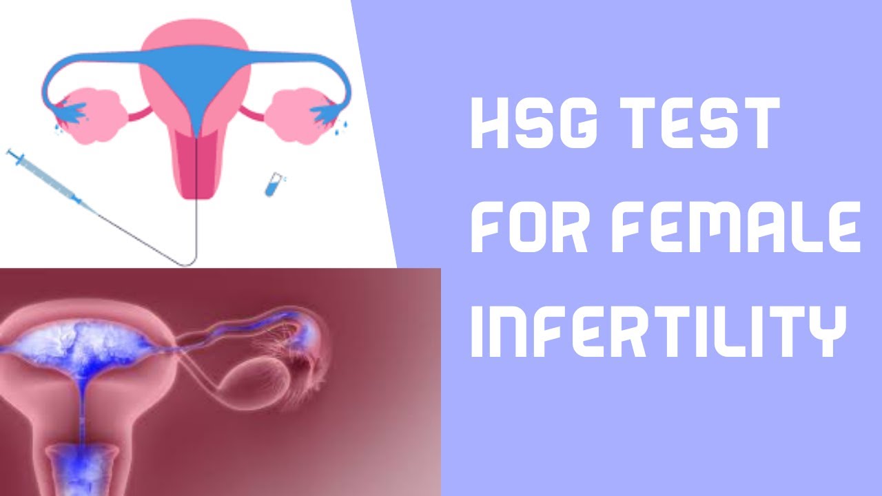 HSG test for female infertility YouTube