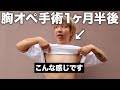 【胸オペ後】1ヶ月検診に行ってきました。
