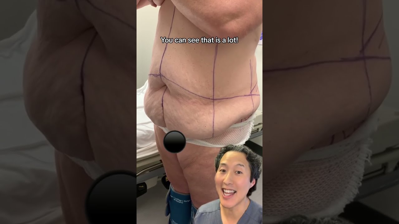 Tummy Tuck After Losing 90 Lbs With Gastric Sleeve Tummytuckbeforeandafter
