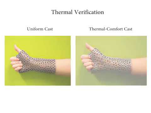 Thermal-Comfort Design of Personalized Casts