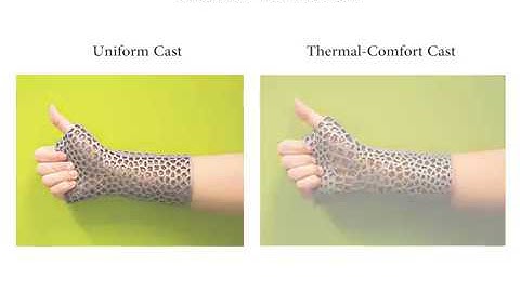 Thermal-Comfort Design of Personalized Casts