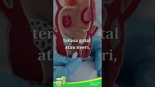 Download Lagu Mengobati Benjolan Wasir #ambeien #ambejoss #wasir #gejalawasir #benjolandianus MP3