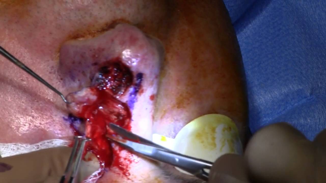 Mohs Reconstruction with Dr. Miller
