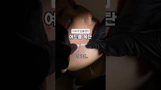 여드름 💣이 터지면..후관리 매우 중요합니다 #흉터지우개 #픽시카겔 꾸준한 관리가, 결국 피부를 바꿉니다 #파모라압출센터 #파메스테틱 #여드름 #피부관리 #피부좋아지는화장품