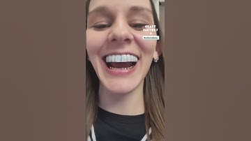 Getting Diamond Grillz After Losing My Teeth 🦷💛 #grillz #veneers #teeth @denturedame