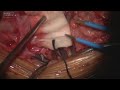 CAROTID ENDARTERECTOMY PART 8