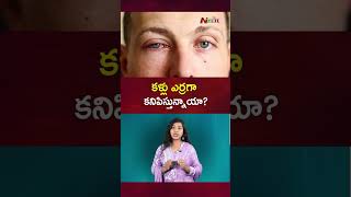 కళ్ళు ఎర్రగా కనిపిస్తున్నాయా ? | Eye Flu Symptoms, Precautions | NTV Life