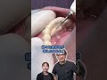 【歯石除去】前歯の裏側にある大きな塊#shorts