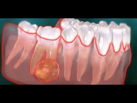 Vidéo: Qui soigne une dent abcédée ?
