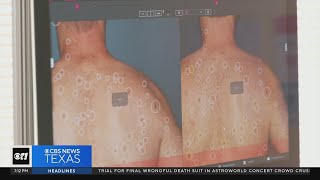 Doctors emphasize the importance of protecting your skin from the sun