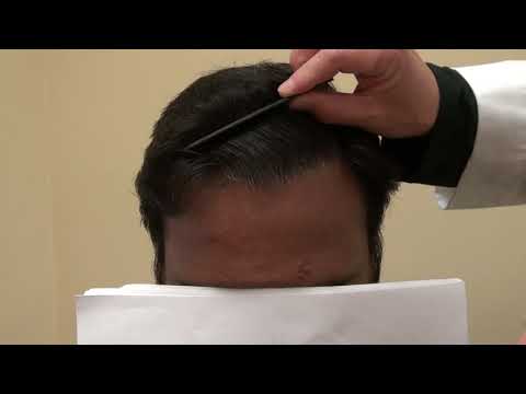 hair-transplant-12th-month-follow-up-restoration-surgery-progress-after-1-year-by-dr.-diep-bald