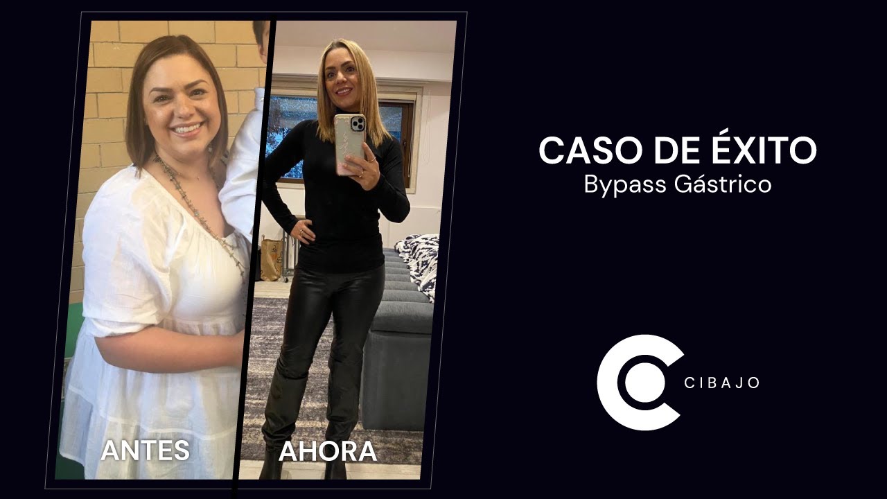 Antes y Despues de Bypass Gastrico de una Anastomosis