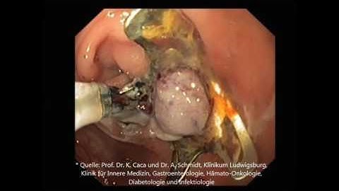 OVESCO OTSC Clip Cutter Remove System