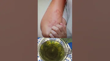 Чай от АЛЛЕРГИИ! Насморк, Зуд в Глазах,  Сыпь и Пятна на Коже, Кашель Пройдут Мгновенно!