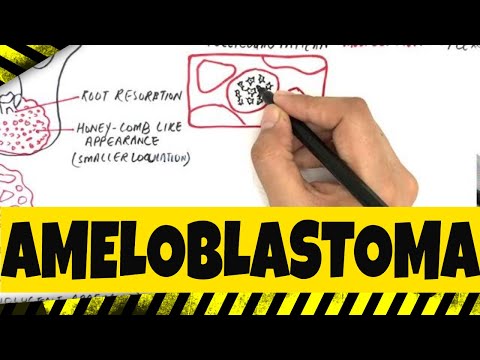 Ameloblastoma - Origination, Clinical, Radiographic & Histopathologic features