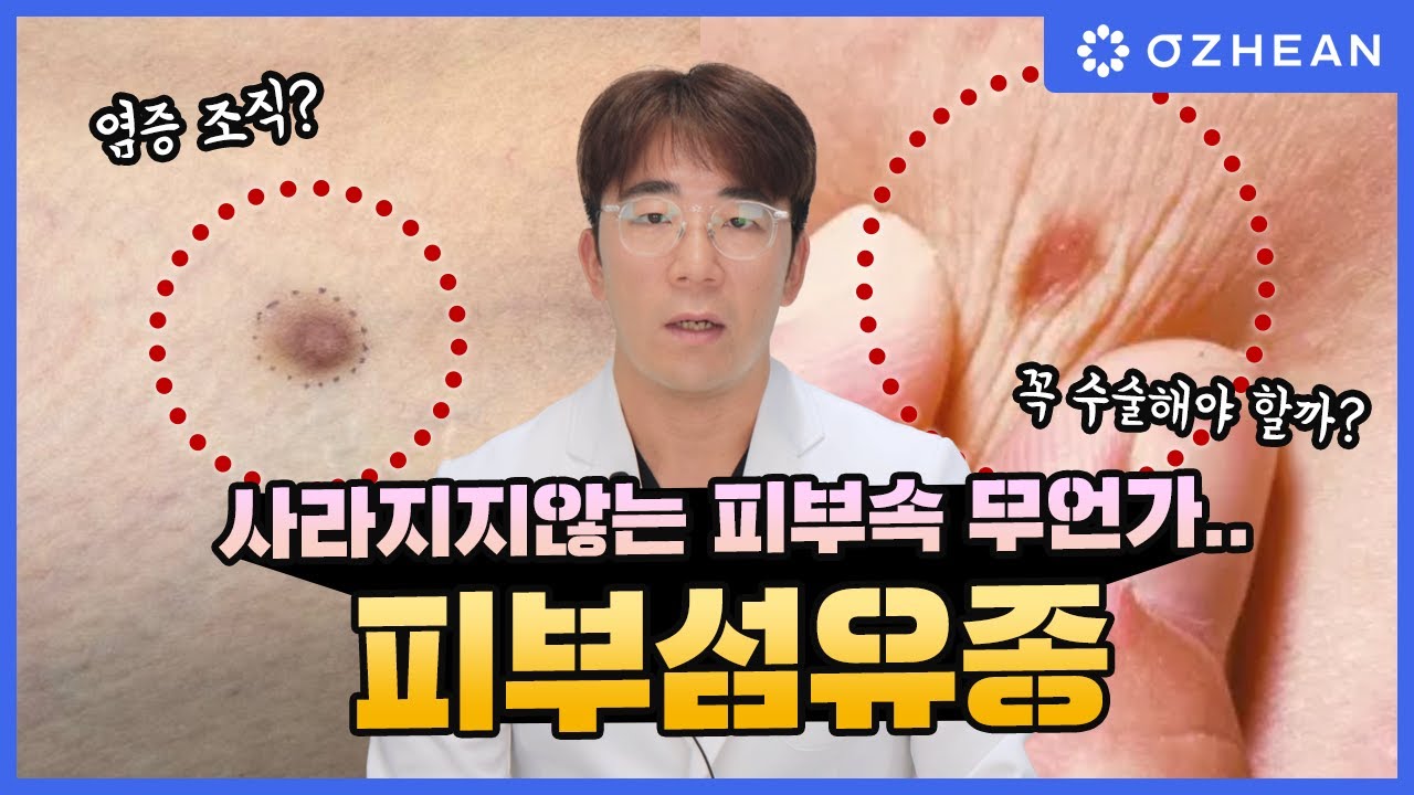 피부 속 딱딱한 무언가 만져진다면? 피부섬유종의 모든 것! - YouTube