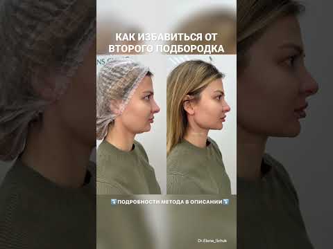 Как избавиться от второго подбородка без хирургического вмешательства