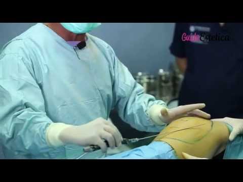 Video: Liposuzione Non Chirurgica