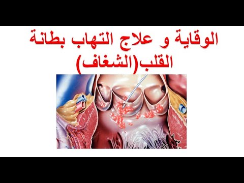 الوقاية و علاج التهاب بطانة القلب أو صمام القلب ؟ الوقاية و علاج التهاب الشغاب او صمامات القلب ؟