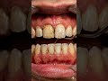Severe Yellow Teeth Whitening Transformation 😳🦷” #teethdecay #dentalcare #satisfying