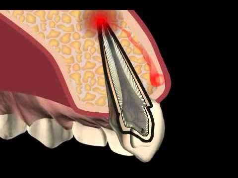 Video: Was ist eine Zahnfistel?