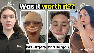 My Second Surgery In Korea - Was It Worth It? Ffs In South Korea