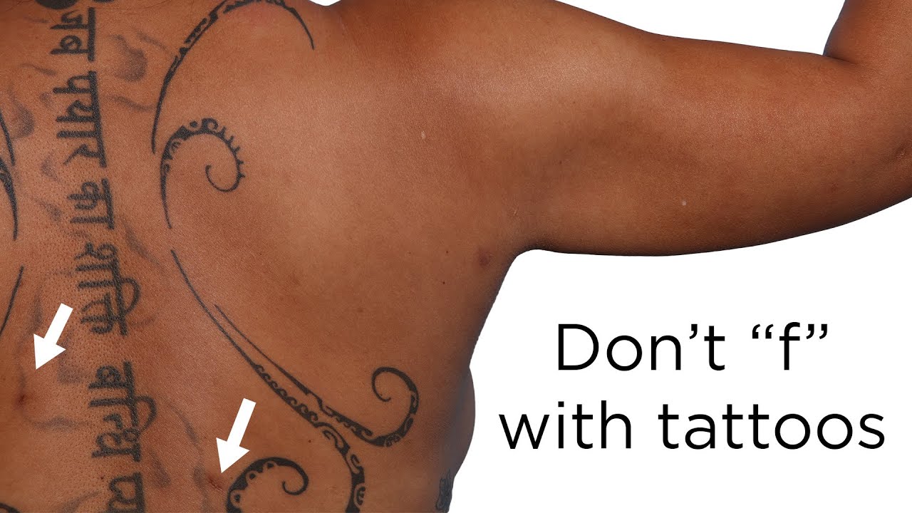 Don’T F With Tattoos | Put Scar Along, Not Within, The Ink | Newport Beach Plastic Surgeon Explains