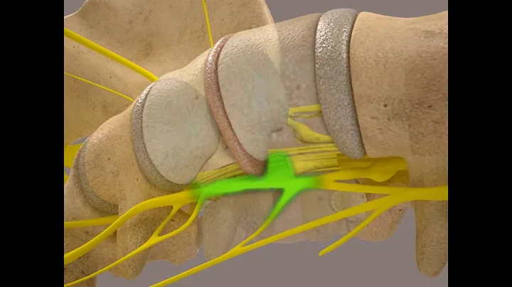 Spinal Decompression Therapy- Advanced Laser Thera...
