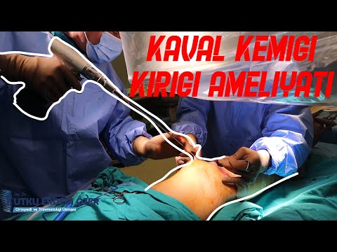 Kaval Kemiği Kırığı | Tibia Kırığı Çivi Ameliyatı || Op. Dr. Utku Erdem Özer