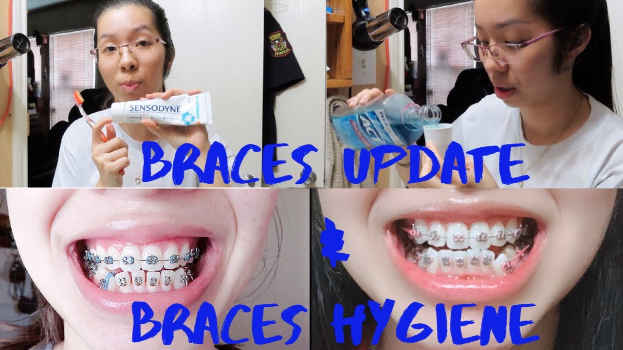 My 4th Braces Update & Cleaning Routine YouTube