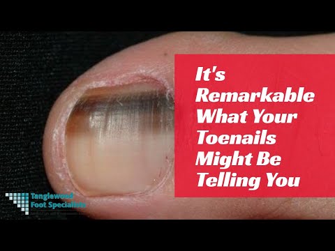 Video: Kaj povzroča porumenelost nohtov na nogah?